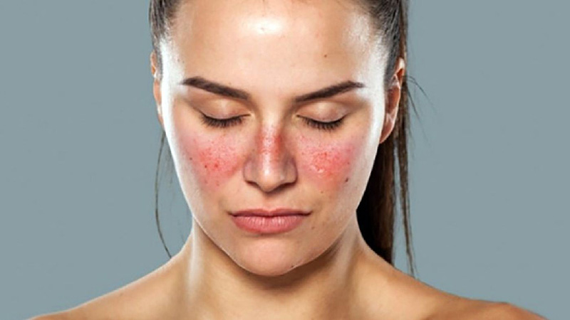 Bệnh lupus ban đỏ là gì