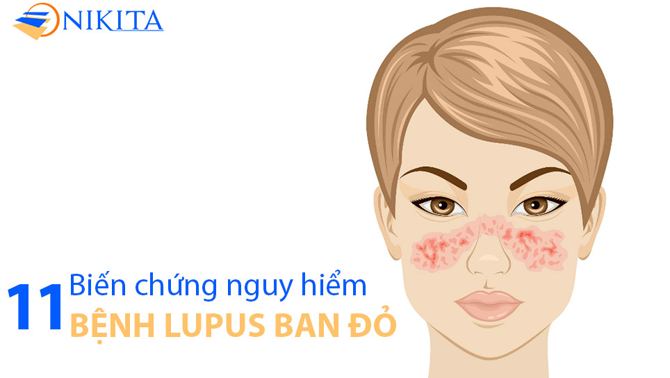 Tìm hiểu về bệnh lupus ban đỏ
